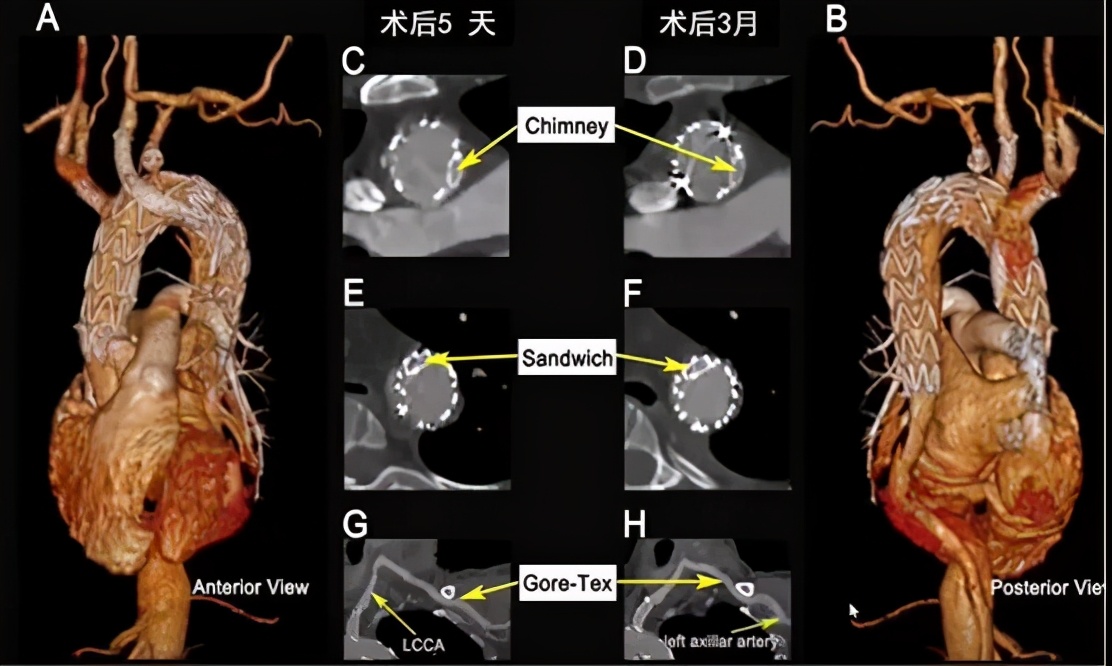 胡佳:升主动脉近端手术后新发弓部病变的腔内治疗