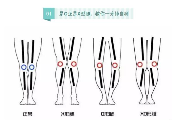 站立时双腿并拢可以矫正o型腿吗,怎么走路可以矫正o型腿