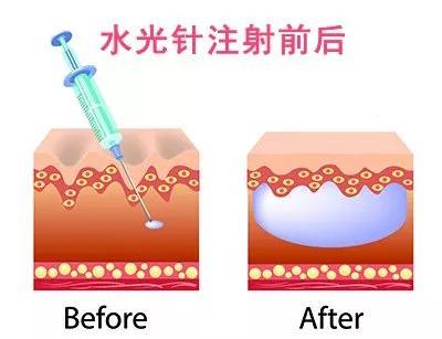补水美白抗皱水光针,美白紧致提亮肤色的水光针