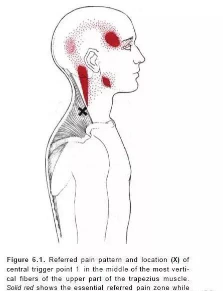 偏头痛的部位是哪里,偏头痛的原始痛点