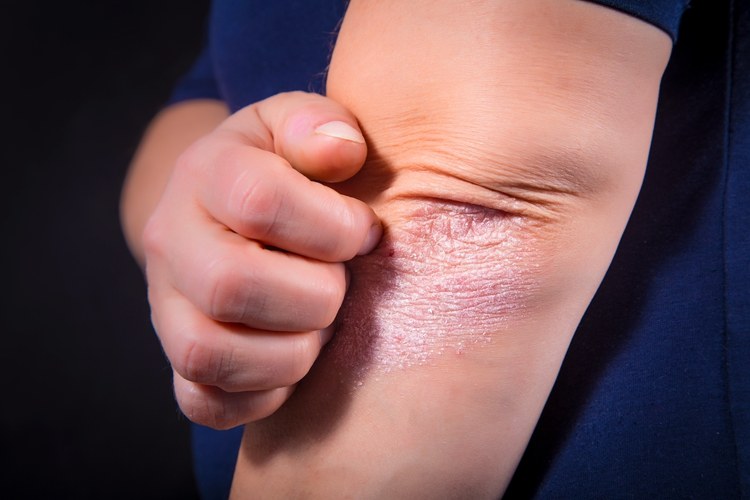 世界银屑病患者人数,银屑病患者的心酸与无奈