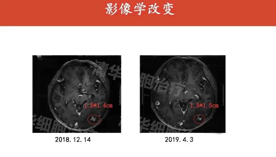 肺癌晚期活不了多久的症状,肺癌晚期生命只剩下六个月