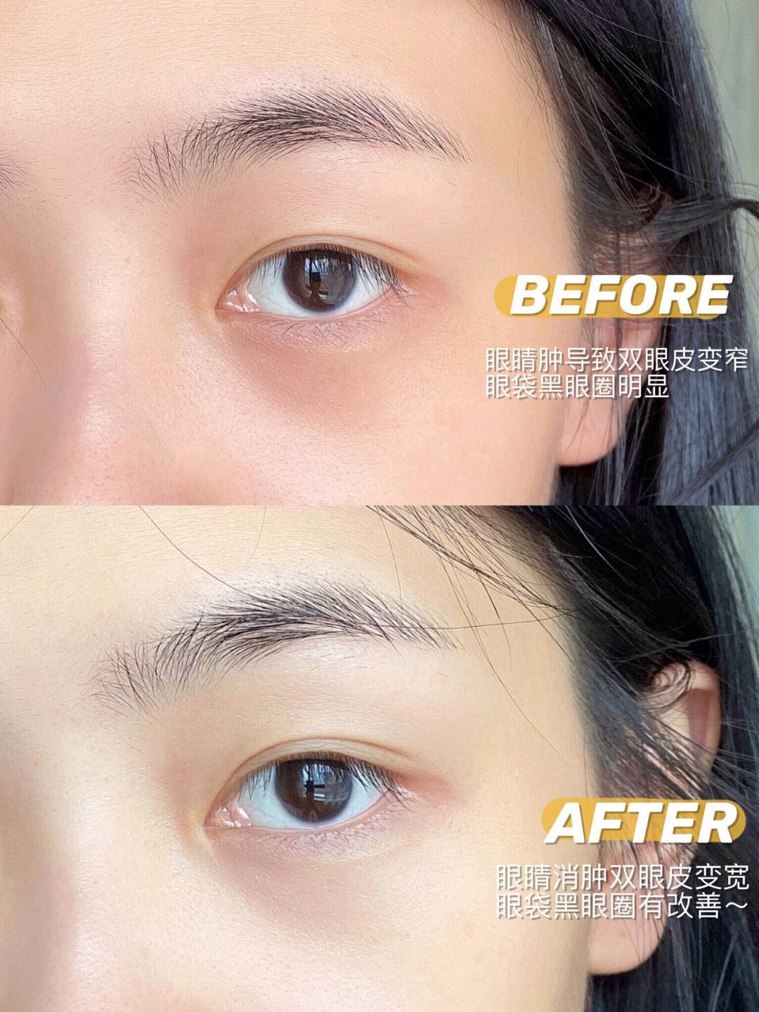 如何有效改善眼周水肿,眼水肿了怎么消肿