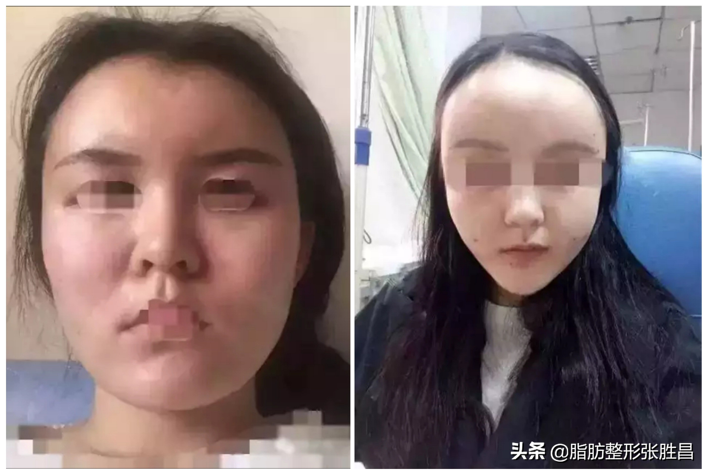 自体脂肪填充变丑了怎么办,自体脂肪填充面部会造成面部变形