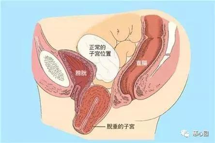 子宫脱垂的六种人群,女性的难言之隐子宫脱垂