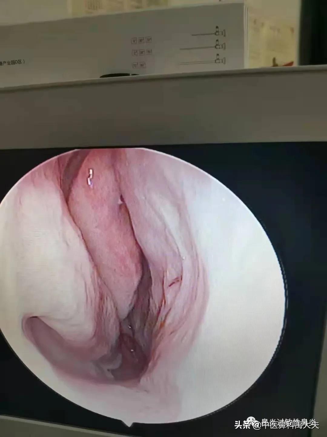 鼻炎的症状和治疗最好方法,常见萎缩性鼻炎或干燥性鼻炎症状