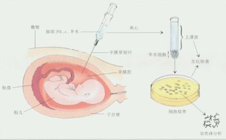 有多少人做羊水穿刺,羊水穿刺要看真实年龄孕周吗