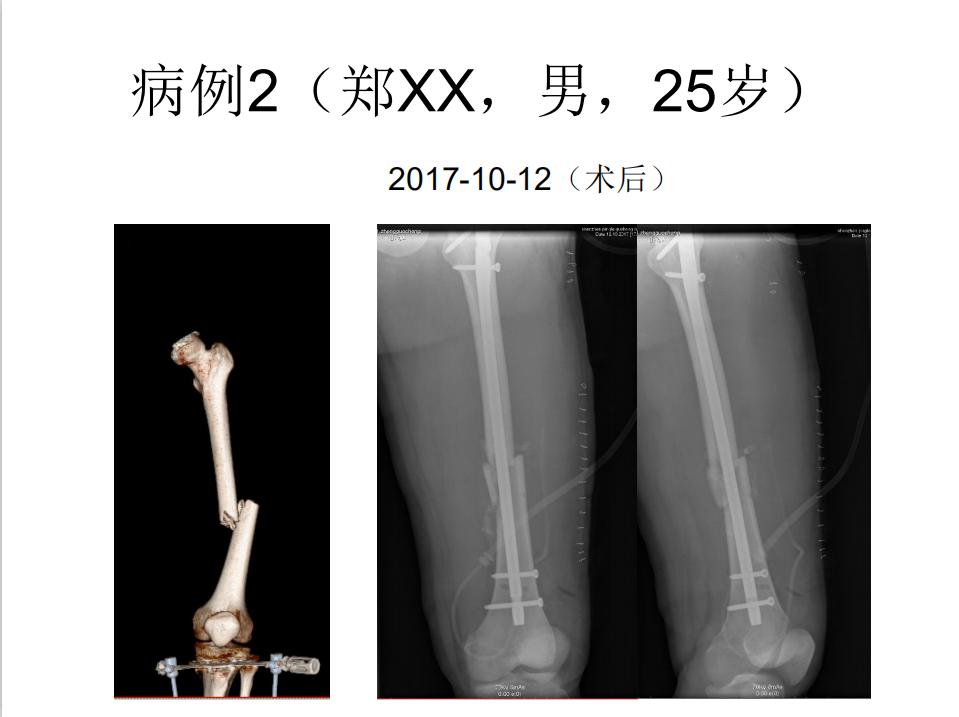平乐骨科推拿教学,中医治疗骨折畸形愈合