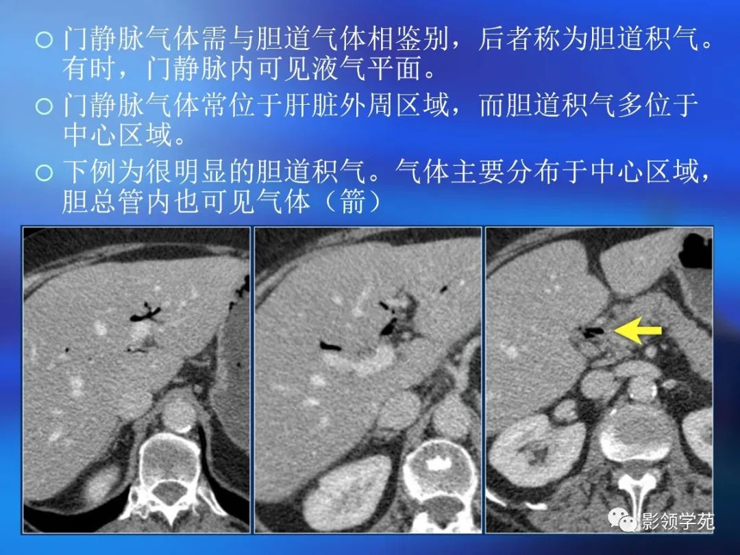 肠道内壁增厚,肠道扩张ct表现