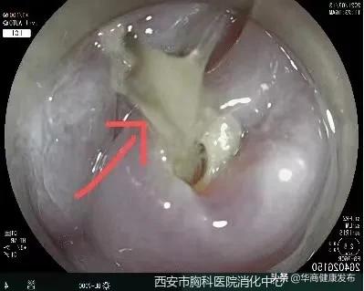 骨鲠,消化内镜可以做什么治疗