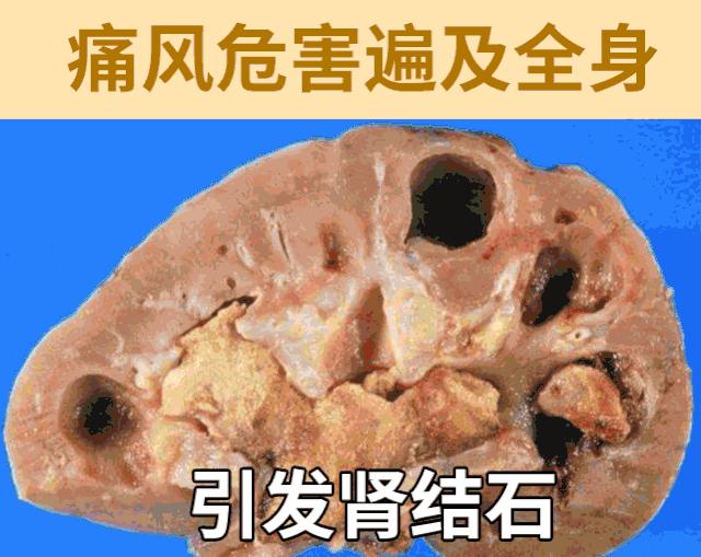 痛风就吃乌鸡白凤丸,乌鸡白凤丸治痛风会有后遗症吗