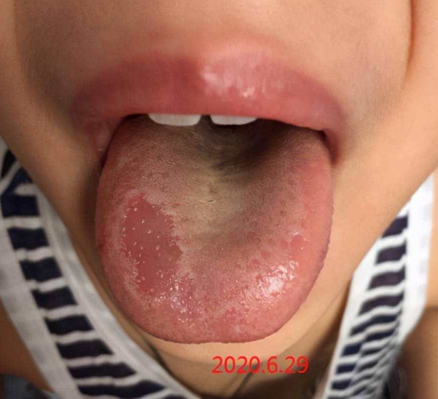 小儿地图舌治疗怎么推拿,儿童地图舌药膳