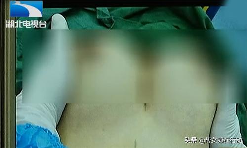 辣妈贷款被打回原形,辣妈隆胸三年后发现假体不见