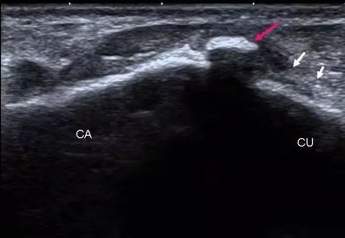 手麻肌电图检查过程视频,手麻脚麻肌电图正常