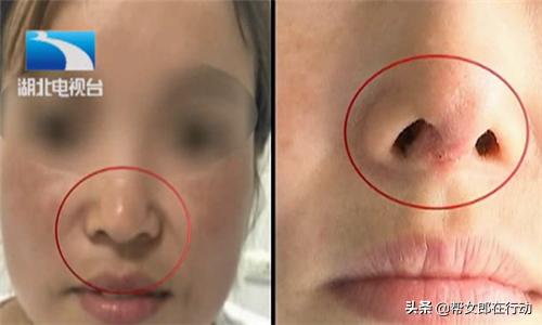 女子隆鼻失败要求免费修复被拒绝,女子隆鼻手术后感染