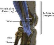 大腿外侧髂胫束综合征快速恢复,跑步如何避免髂胫束综合征