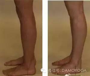 膝反屈的治疗方法,膝反屈是什么意思