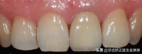 烤瓷牙能用美白牙贴吗,牙贴美白烤瓷牙