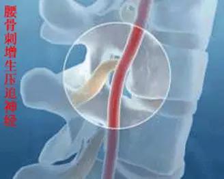 颈椎腰椎疾病ct及mri诊断,腰椎ct可以发现肠部病变吗