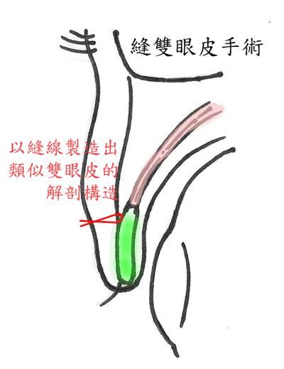 双眼皮眼袋手术揭秘,双眼皮手术时最全攻略