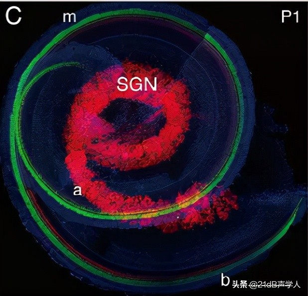 用了人工耳蜗可以听音乐吗,用人工耳蜗可以和正常听力一样吗