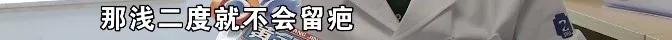 烫伤后不要过于紧张,烫伤后紧急处理