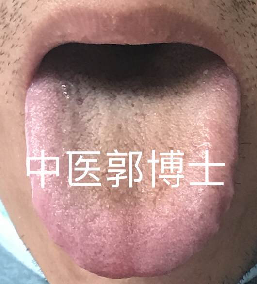薄苔是什么症状,薄舌苔