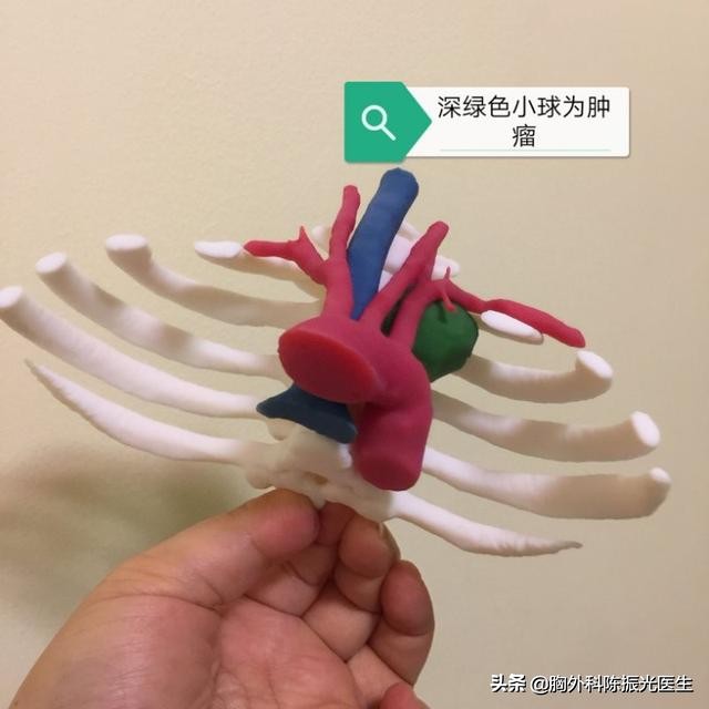 后纵隔恶性肿瘤怎么样,后纵隔占位肿瘤几率大吗