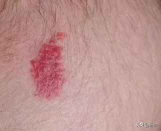 草莓斑胎记,草莓血管瘤胎记