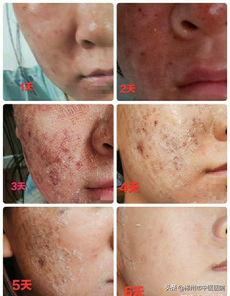 二氧化碳点阵激光被坑,二氧化碳点阵激光之后反黑怎么办