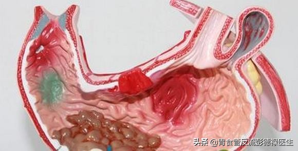 为什么胃炎不能彻底治愈,多年的胃炎怎么治