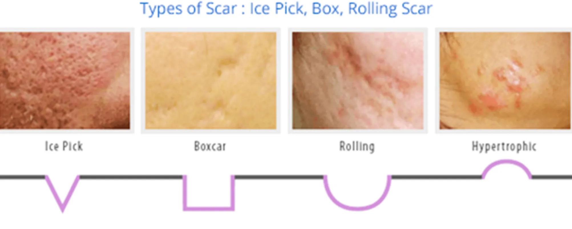 面部生疮后的瘢痕怎么办,疮疤去除