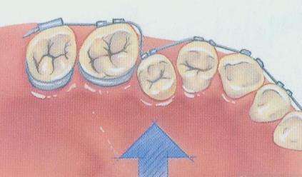 牙齿矫正有什么办法减轻疼痛感,牙齿矫正传统矫正vs隐形矫正