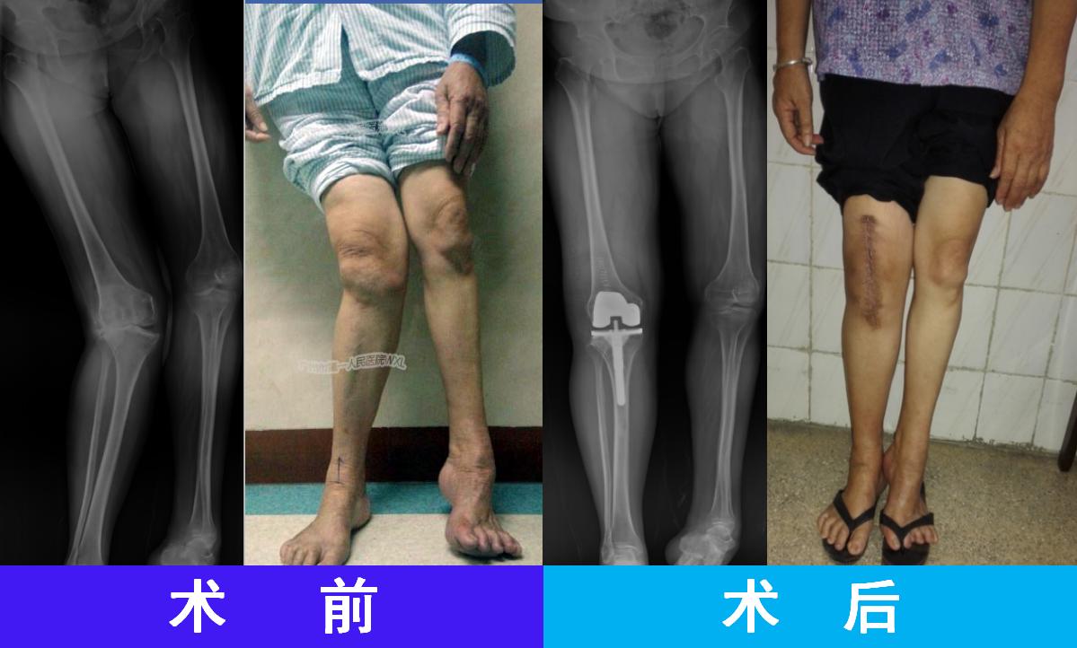 膝关节骨性关节炎症状及治疗,膝关节骨性关节炎诊疗指南下载