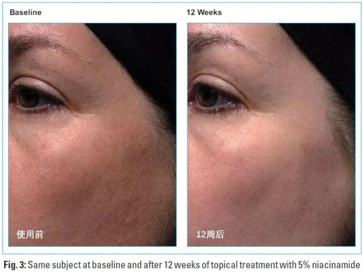 用了烟酰胺的脸变黑了需要停用吗,用了烟酰胺停用会反弹吗