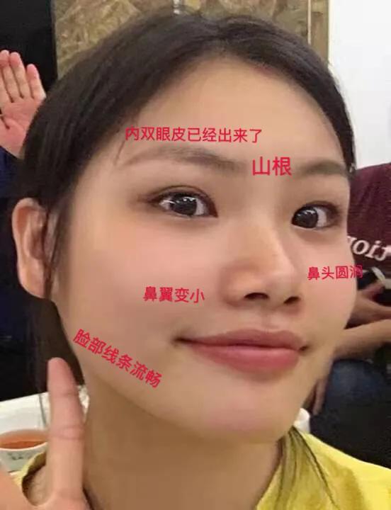 逆袭塌鼻子,逆袭鼻子