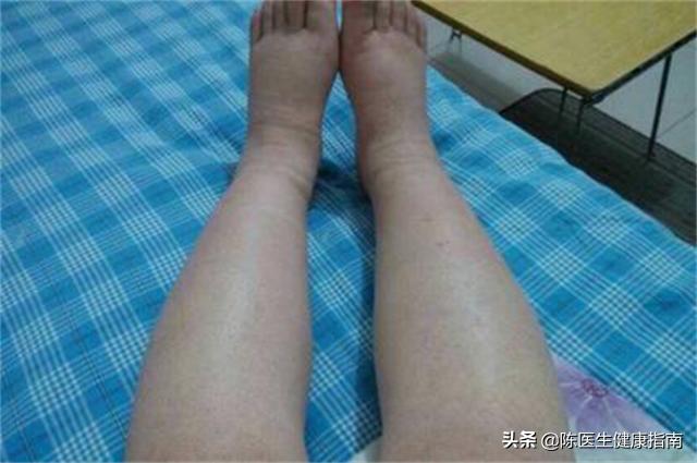 吃硝苯地平水肿如何处理,吃硝苯地平出现水肿副作用