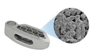 世界首例3d打印骨植入,华西医院假体植入