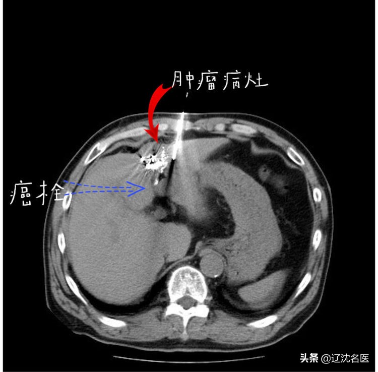 肝癌做放射性粒子治疗有什么影响,乏力查出来癌症