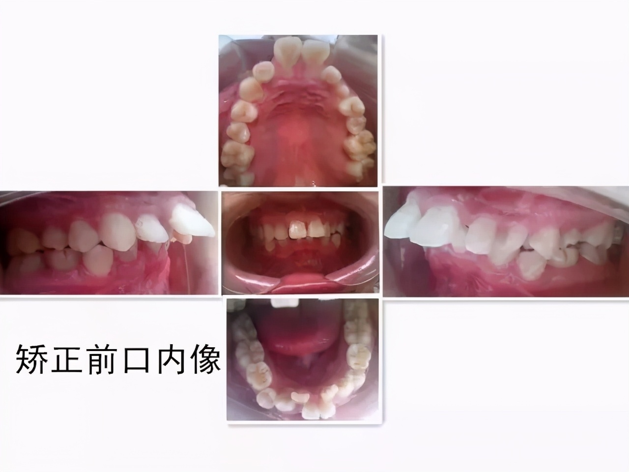 成年人牙齿矫正戴上牙套嘴巴变凸,扩弓会使脸型变大吗