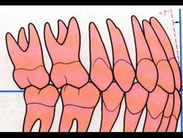 补牙后牙齿一敲就疼是咋回事呢,补牙的时候磨牙钻心痛怎么办