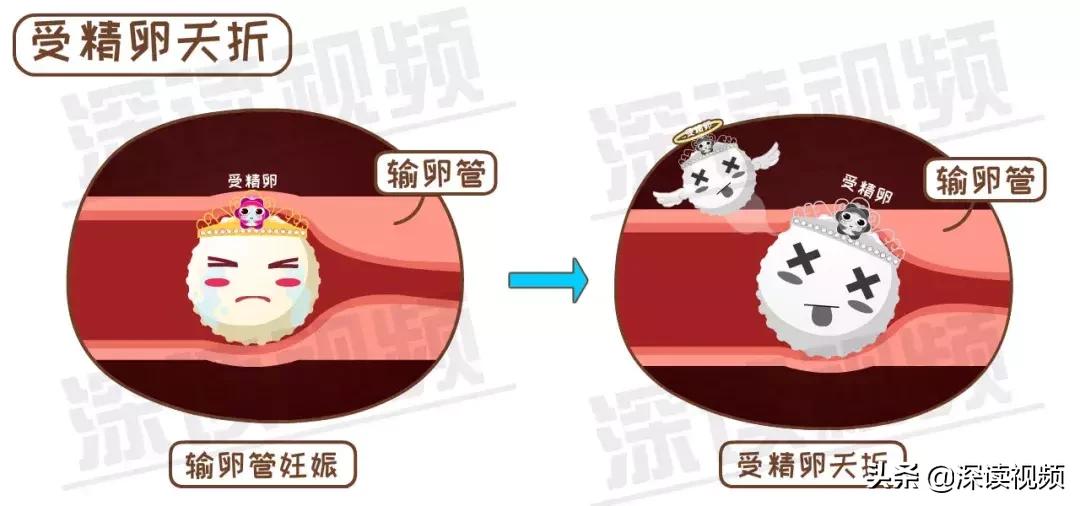 宫外孕有哪些习惯,怎样不容易宫外孕