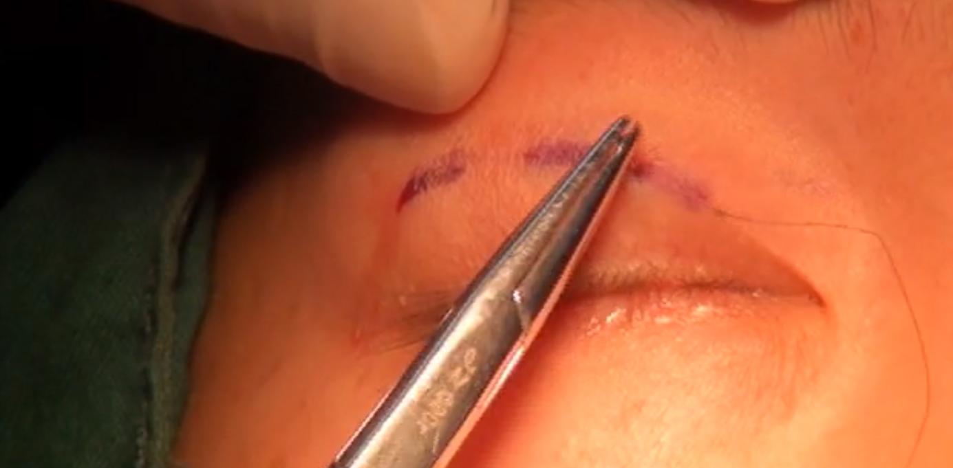 双眼皮科普小课堂:双眼皮的三种术式及术后护理