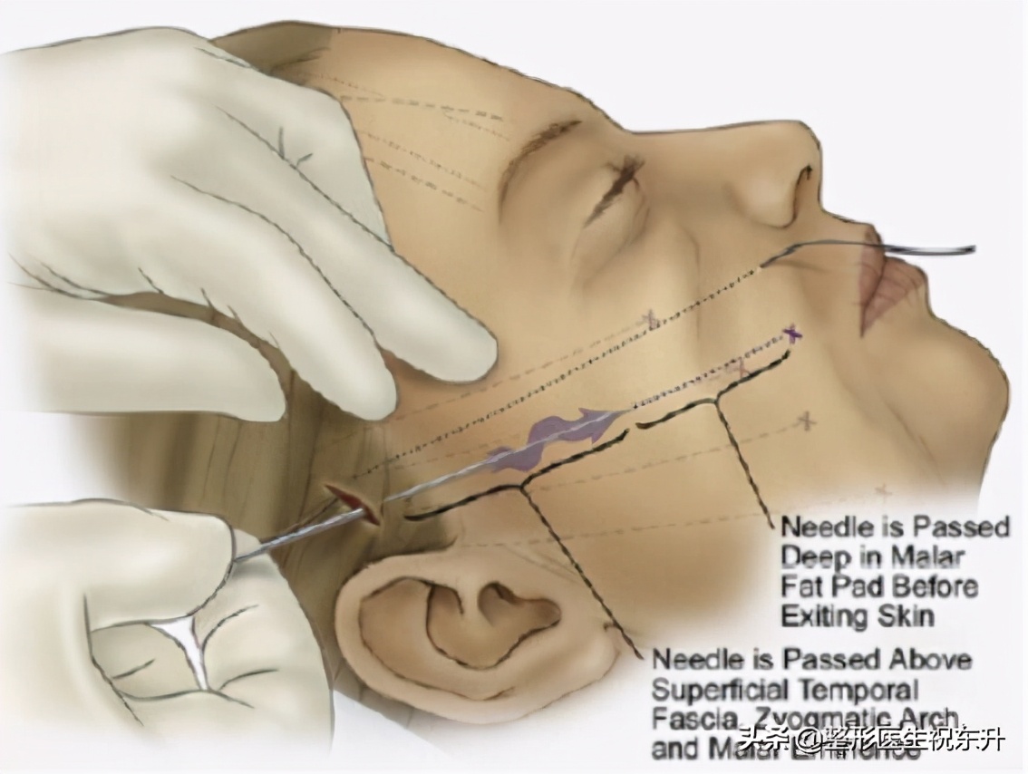 线雕隆鼻真相大揭秘,关于线雕十大热门问题解答