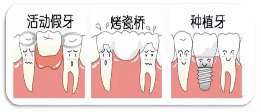 烤瓷牙桥适用于什么,烤瓷桥好处