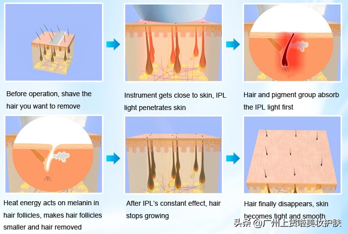 paa美容抗衰和光子嫩肤哪个好,美容光子嫩肤有什么作用