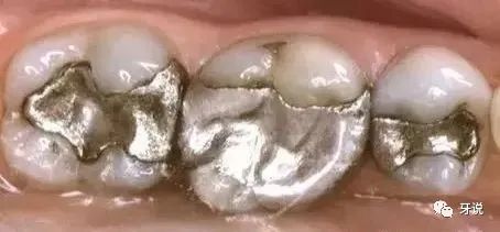 补牙最好的材料是什么,什么材料补牙洞最好