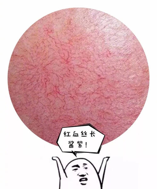 脸上有红血丝怎么修复小窍门,脸上红血丝怎么修复最好有效