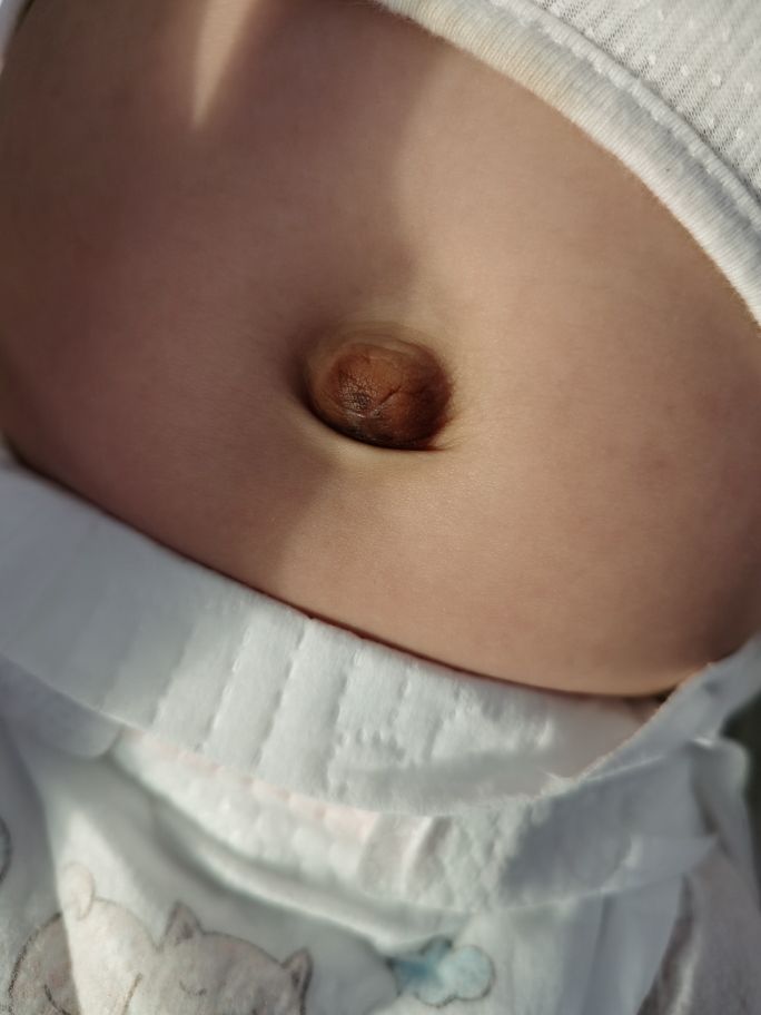 新生儿肚脐多久脱落21天,婴儿肚脐脱落后湿的怎么护理