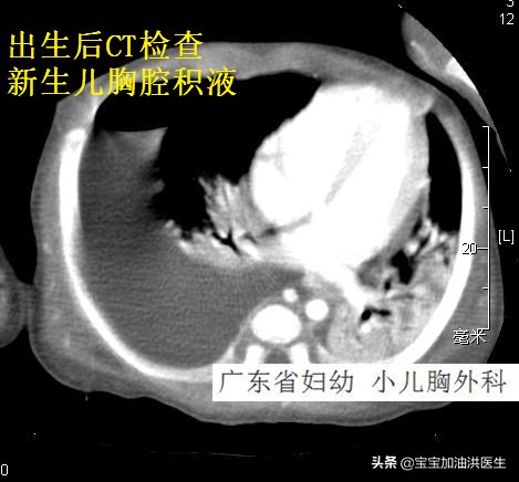 #洪医生看出生缺陷#-胎儿胸腔积液